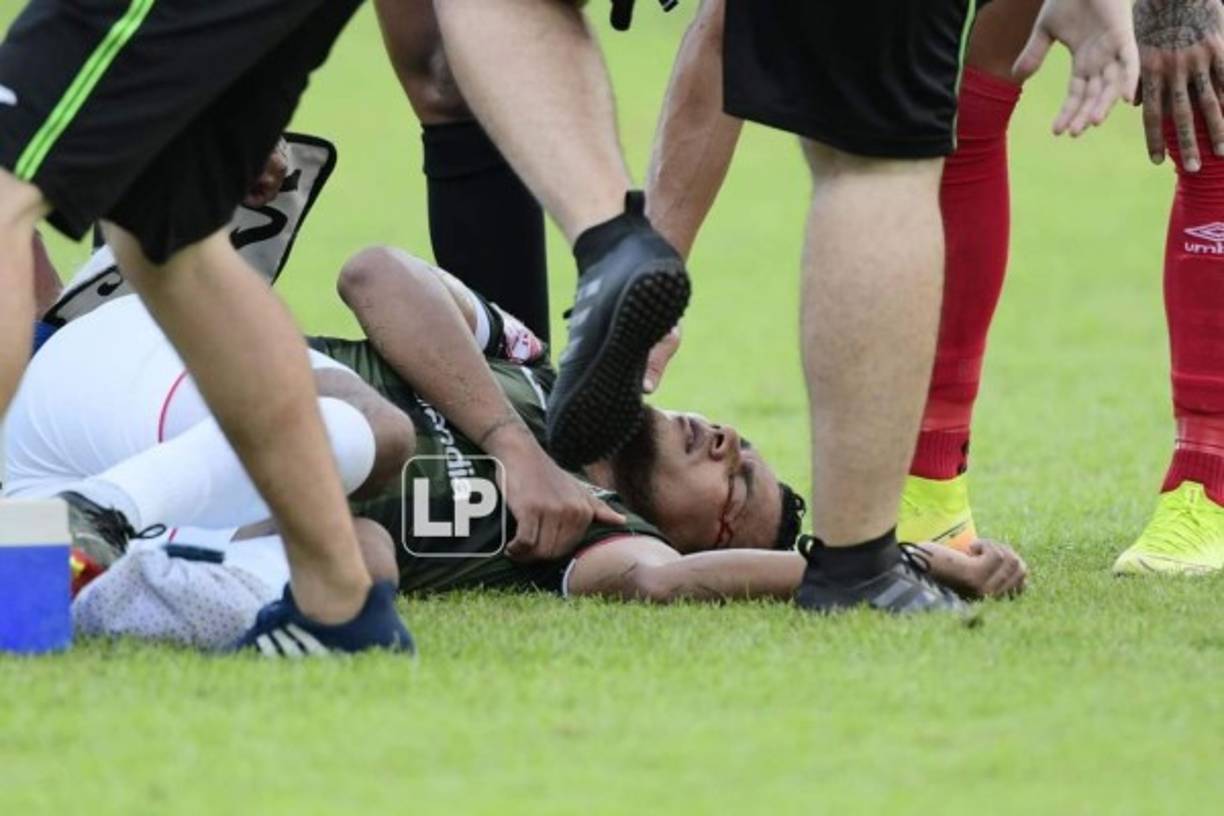 Mario Martínez con el rostro ensangrentado tras recibir un codazo de Jonathan Paz, que no fue expulsado.