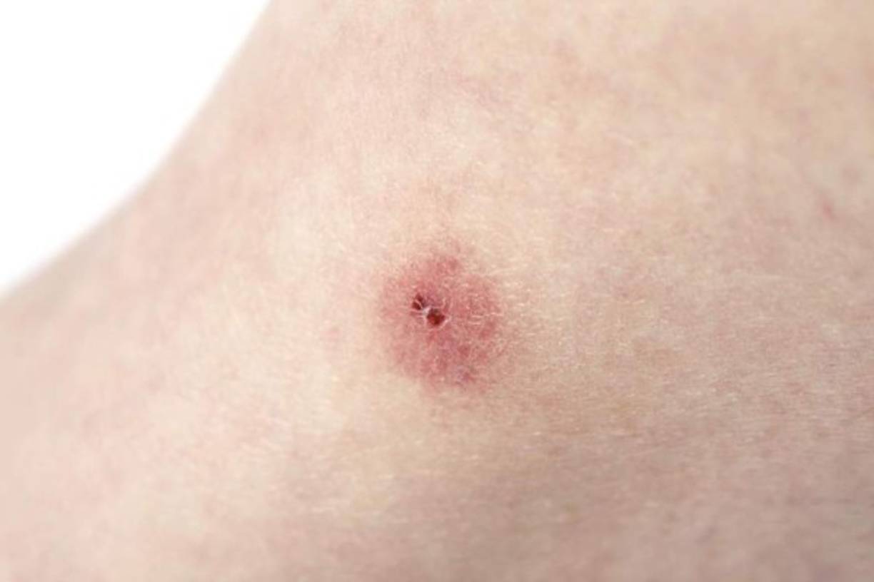 Aliviar la irritación de las picaduras de insectos. Aplicar una gota de pasta de dientes a una picadura de insecto para detener la picazón y disminuir la inflamación.