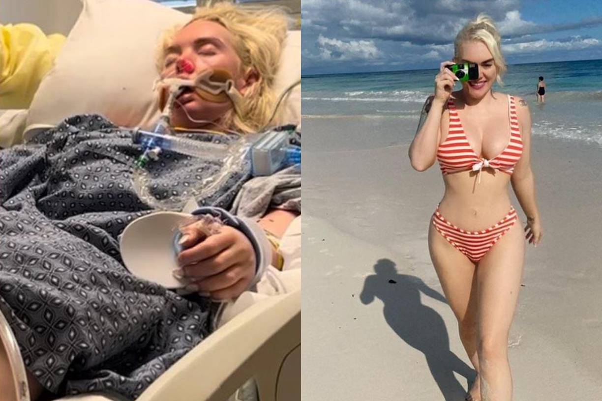 La modelo estadounidense Jennifer Barlow se infectó con la bacteria tras sufrir un corte durante sus vacaciones en Bahamas. 