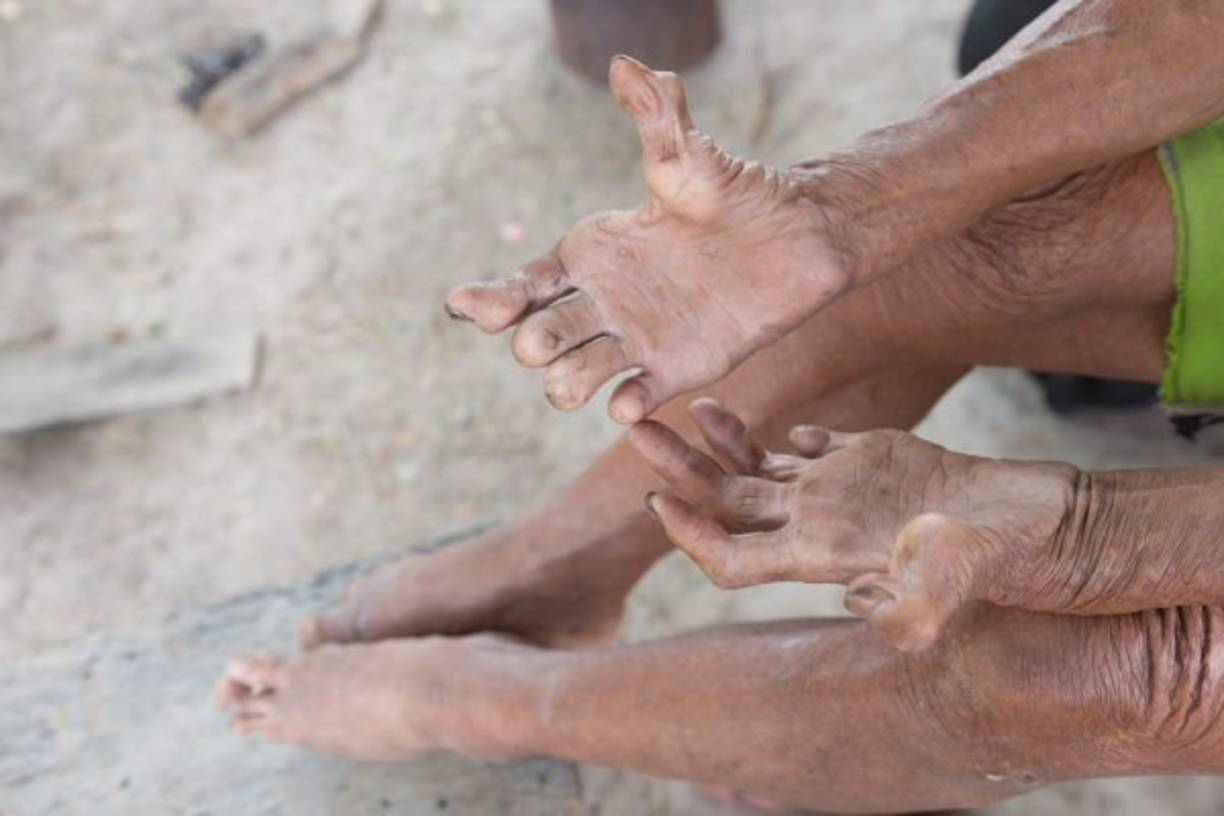 Sinaloa es la entidad con más casos de lepra al contabilizar un total de 32 pacientes, de los cuales 15 son masculinos y 17 son femeninos. <br/><br/>Le siguen Michoacán, que cuenta con 15 casos (8 hombre y 7 mujeres); Jalisco con 6 (cinco hombres y una mujer); Nayarit con 5 (un hombre y cuatro mujeres); Chiapas con 4 (tres hombres y una mujer); y Nuevo León también con 4 (dos hombres y dos mujeres). <br/><br/>Mientras que los estados que tienen entre uno y tres casos son: Estado de México (1), Morelos (1), Oaxaca (1), Aguascalientes (1), Baja California (2), Coahuila (2), Guanajuato (2), Quintana Roo (2), Tamaulipas (2), Colima (3), Guerrero (3), Yucatán (3).
