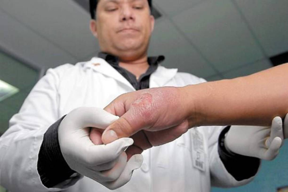 La leishmaniasis es una enfermedad parasitaria diseminada por la picadura de un mosquito infectado. Existen varias formas distintas. 