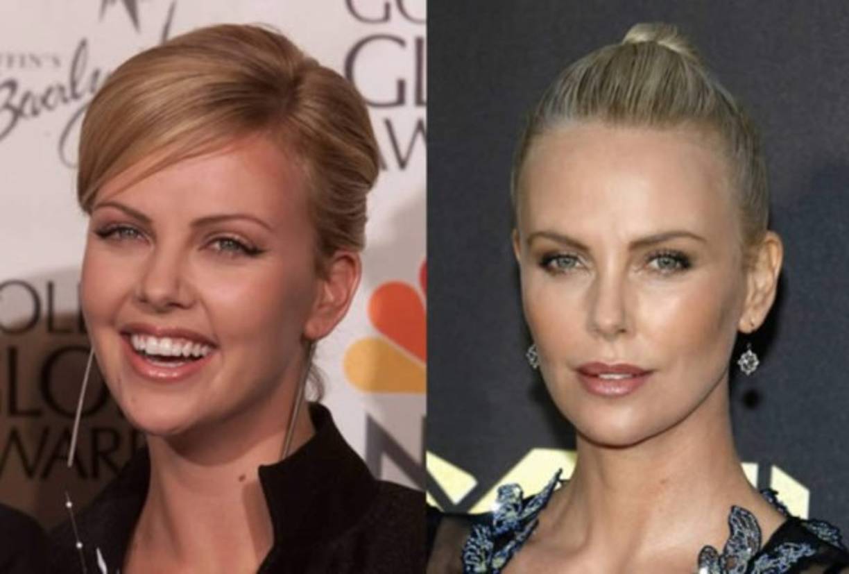 En cuanto a Charlize, de 44 años, el cambio todavía no es tan drástico, pero sí evidente.<br/><br/>'Charlize tiene las cejas más definidas y tiene la mirada más abierta. También se hizo los pómulos con ácido hialurónico, los cuales reflejan un rostro más afilado. Podría haberse realizado también tratamientos para reestructurar el rostro, sobre todo en la parte inferior, en la línea mandibular y el mentón', afirma el doctor Gustavo González.<br/>