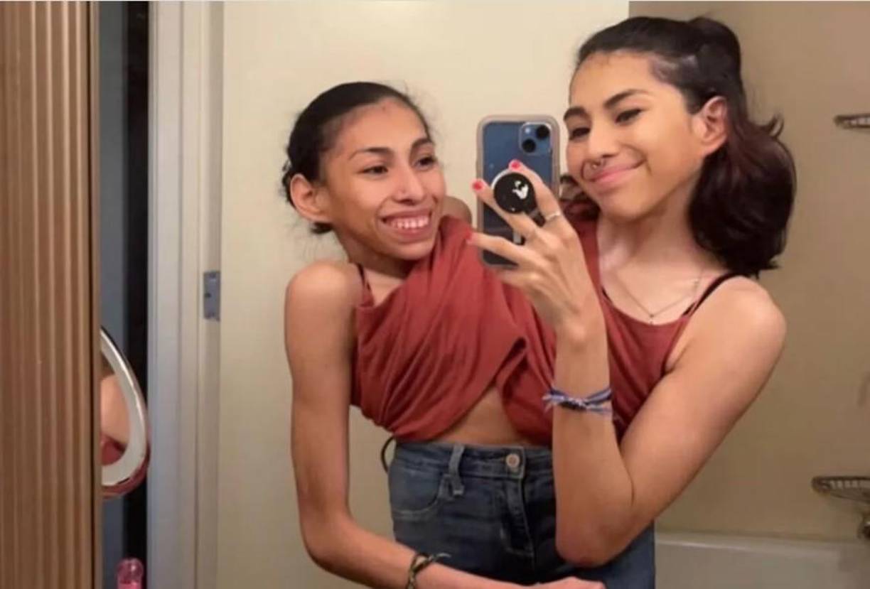 Debido a su condición genética, Carmen y Lupita han enfrentado numerosos desafíos a lo largo de su vida. Uno de los primeros fue aprender a caminar con una sola pierna cada una. Aunque este fue un reto significativo, no ha sido el único y quizás no sea el último que tengan que enfrentar.