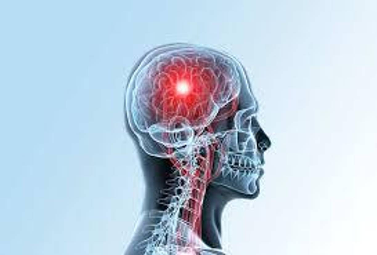 El accidente cerebrovascular isquémico ocurre cuando un vaso sanguíneo que irriga sangre al cerebro resulta bloqueado por un coágulo de sangre. Esto puede suceder de dos maneras: