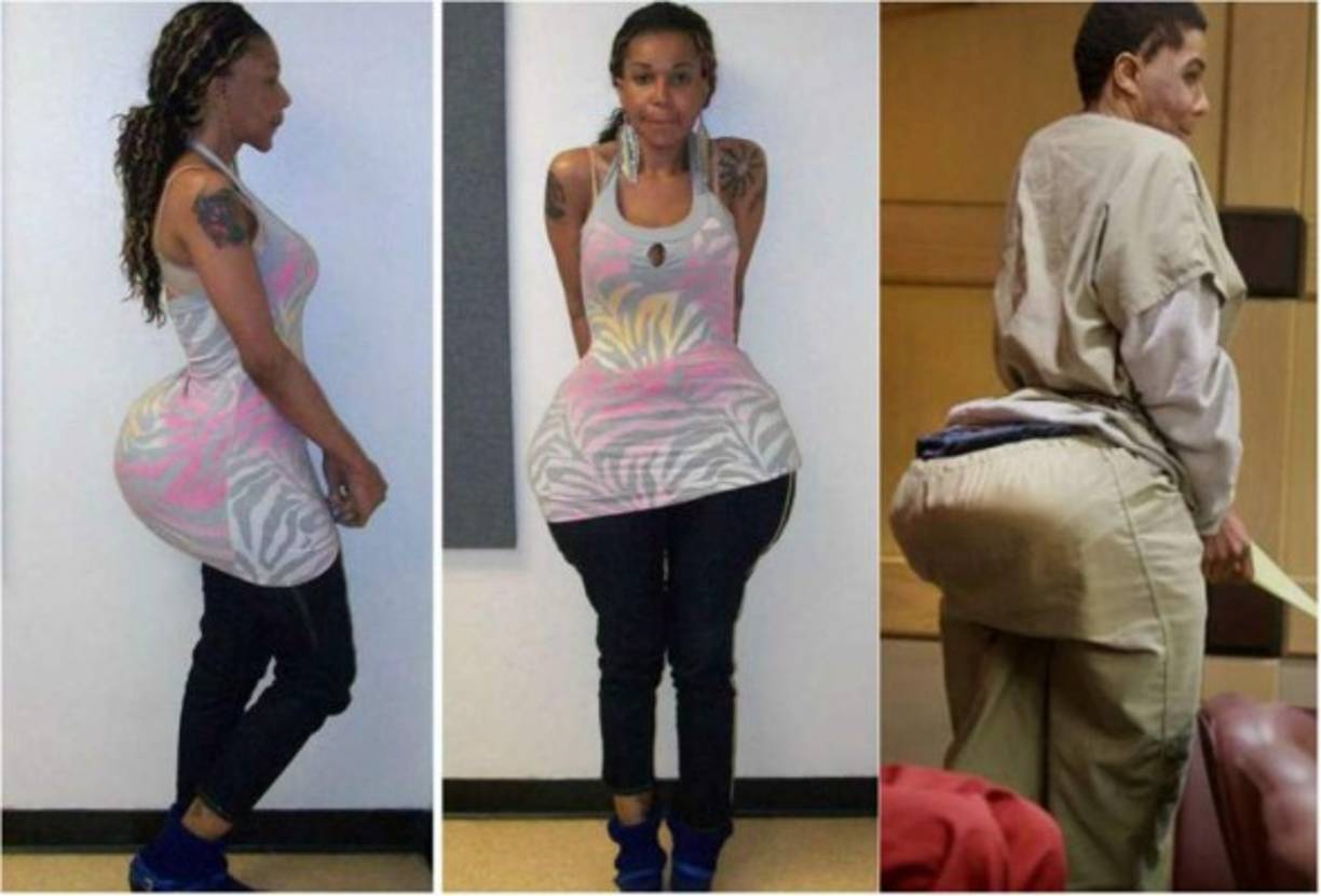 Una falsa doctora que supuestamente inyectó cemento y otras sustancias en los glúteos de las mujeres que se sometían a cirugía estética en su consultorio fue condenada a diez años de prisión en el estado de Florida, por homicidio culposo. Oneal Ron Morris, 36, conocida como 'La duquesa' y originaria de Cuba, fue sentenciada por operar sin licencia y por el homicidio involuntario de una paciente que murió en 2012 tras pasar por sus manos.