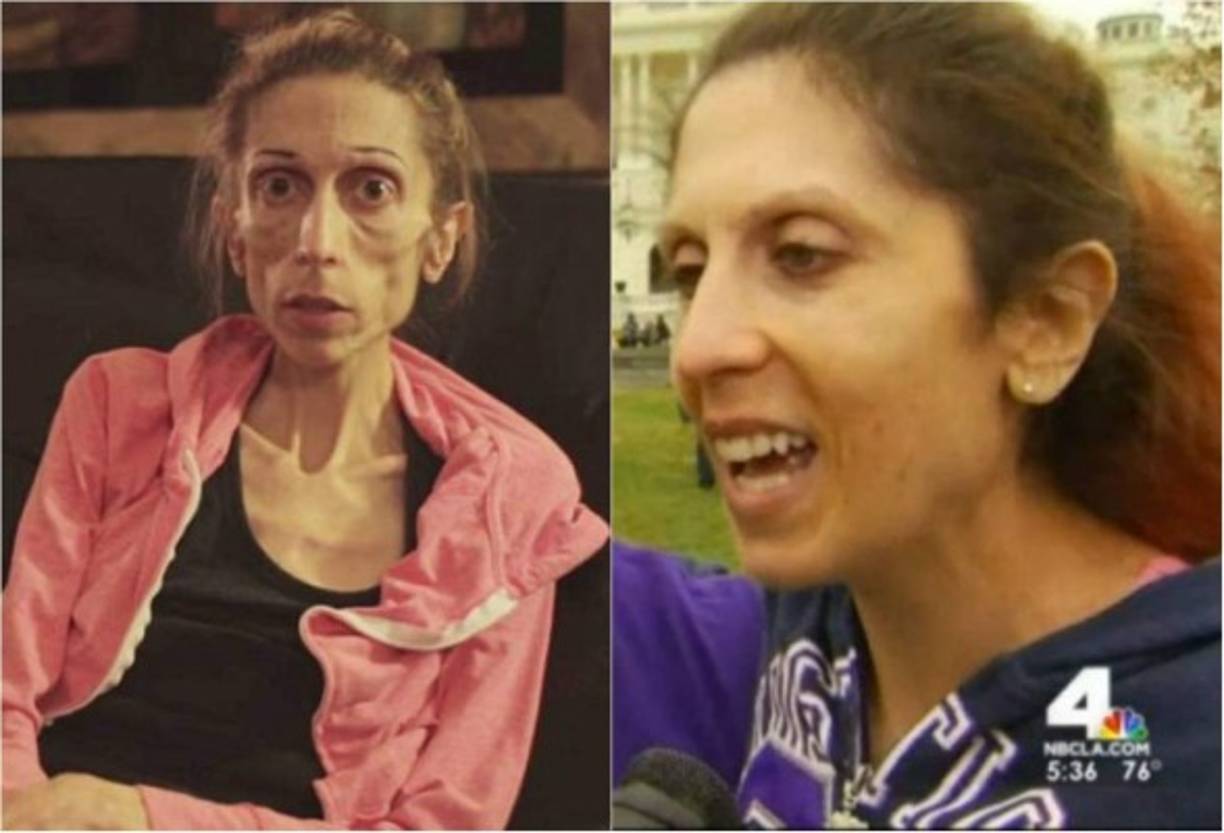 Tras someterse a tratamiento, la joven brindó una entrevista el pasado fin de semana en la segunda Marcha anual contra los Desórdenes Alimenticios, donde se le vio mucho más recuperada.