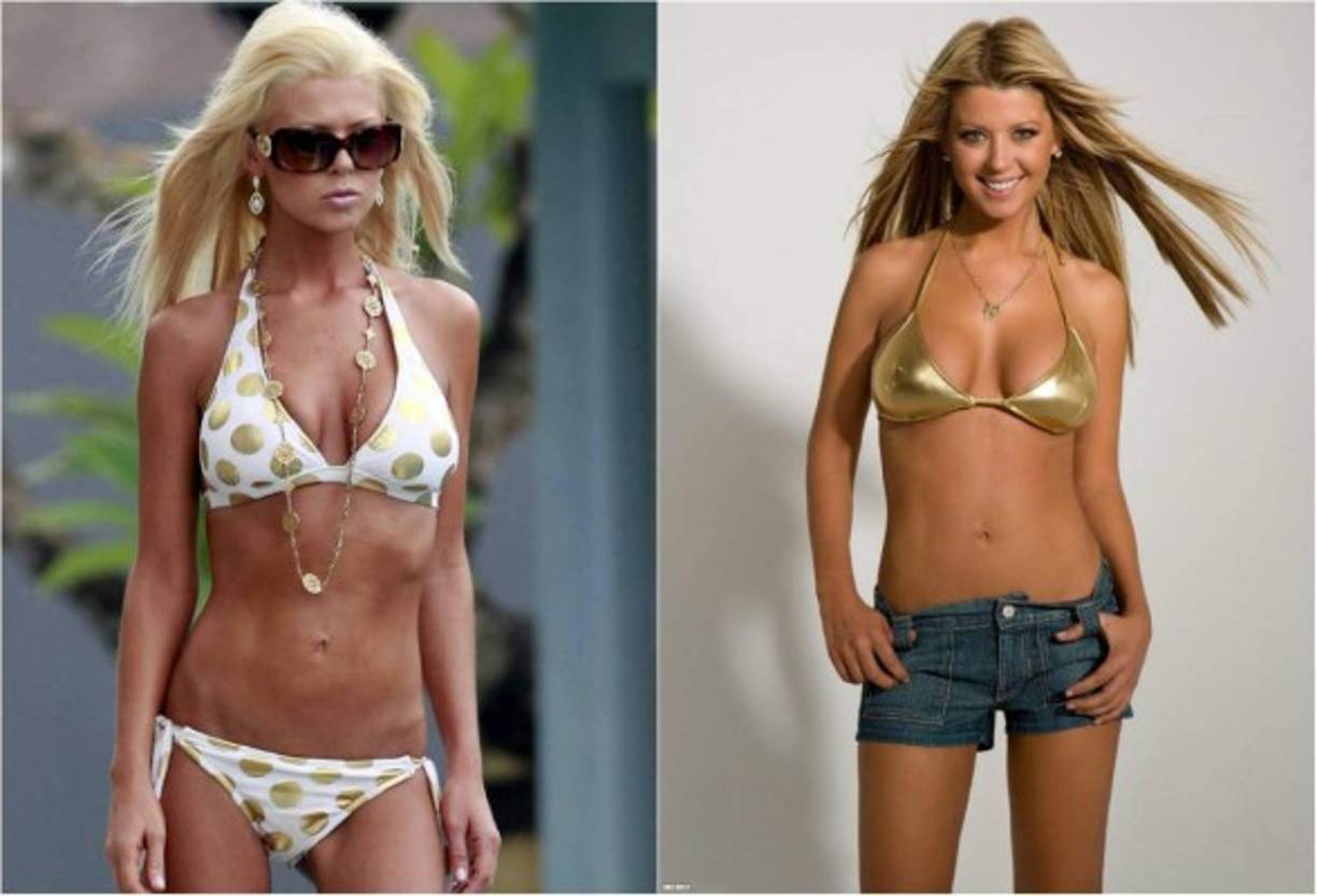 Tara Reid. La delgadez extrema de la actriz ha llamado la atención de los medios de comunicación estadounidenses. Sin embargo, la ex miss reina de belleza no ha admitido sufrir de bulimia o anorexia.