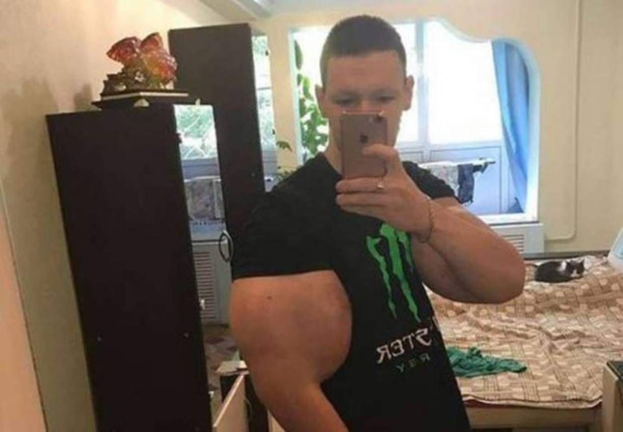 “Se inyectó tres litros en cada brazo. Saturó los tejidos musculares y bloqueó el flujo sanguíneo”, comentó el cirujano Dmitry Melnikov, según cita el medio La Sexta.