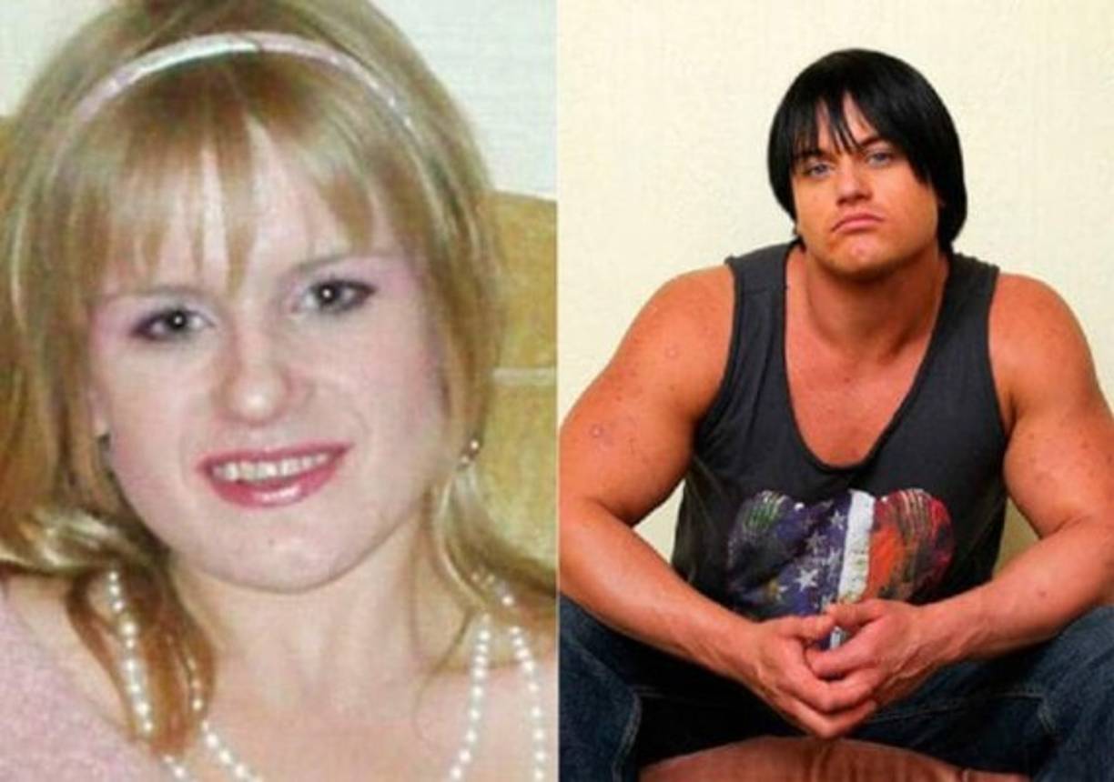 CANDICE ARMSTRONG: Quería cumplir su sueño de ser fisicoculturista. Lo hizo, sin embargo optó por el camino más rápido. Hoy sufre las terribles consecuencias de tomar esteroides, la 'trenbolona' en particular.