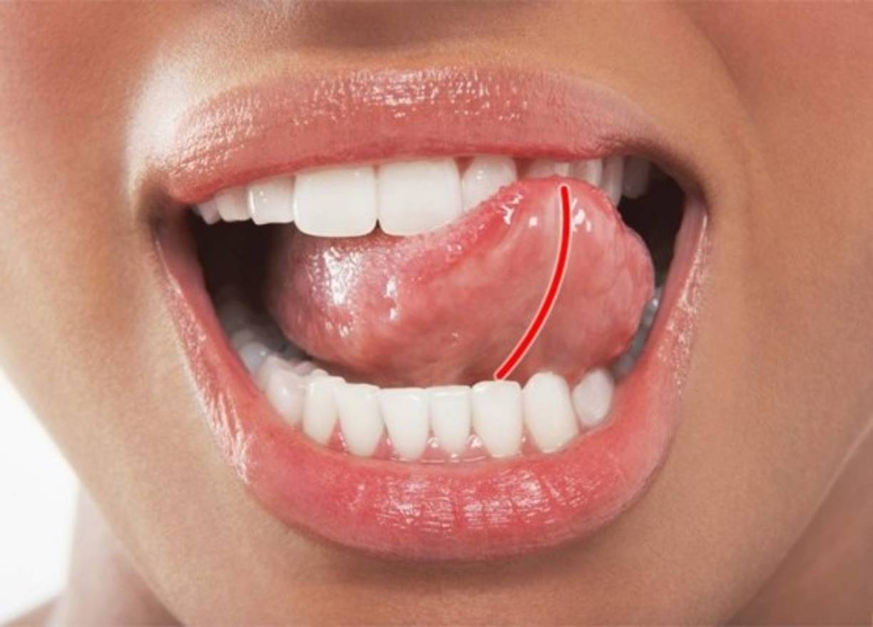 FRENILLO LINGUAL. Este pequeño pliegue membranal debajo de la lengua tiene una función muy importante: fija la lengua en la cavidad bucal y hace que la lengua sea más móvil.<br/>Esto, a su vez, ayuda a evitar la glosoptosis (estrangulación por tragarse la lengua accidentalmente). Es especialmente importante para los recién nacidos que aún no han aprendido a controlar todos los órganos de su cuerpo.