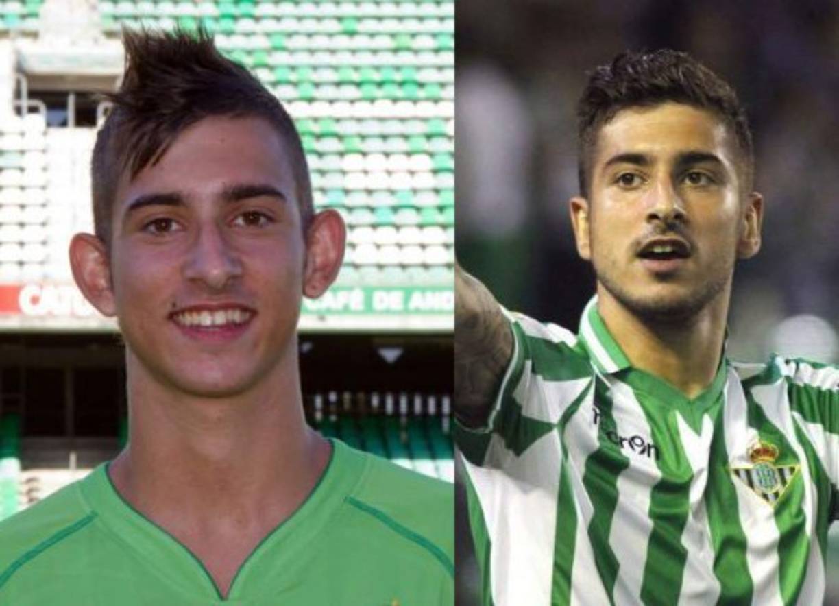 Álvaro Vadillo decidió pasar por el quirófano para arreglarse las orejas. El atacante debutó a muy temprana edad en Primera División, y enseguida decidió renovar su imagen para dejar atrás sus llamativas orejas.