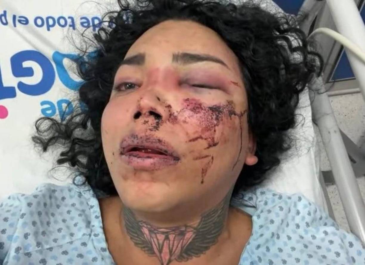 La ganadora de primera temporada de ‘La Casa de los Famosos México’ detalló que Paola Suárez tiene un hematoma en el ojo, además el tabique de la nariz lo tiene desviado por lo que necesita una cirugía, además tiene un tobillo muy inflamado. “Ahorita nosotras nos la queremos llevar a otra clínica para que este más tranquila porque afuera esta el hospital público, el ‘General Regional’, entonces hay mucha gente y la gente quiere entrar”, explicó Guevara.