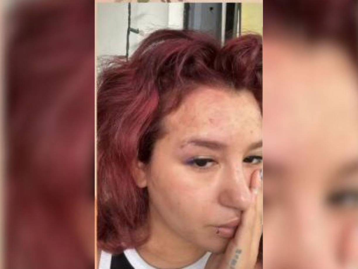 Continuó. “Fui con mi doctor y me comentó que, probablemente, se debía al estrés y la ansiedad que había estado viviendo en los últimos días. Luego, empecé a sentir un ardor en la misma zona de la cara, pero una sensación totalmente desconocida, era, literal, como agujas en la frente. Y empecé a ver que me que me salían manchas rojas en la frente y en el párpado derecho. Fue ahí donde me empecé a preocupar y fui otra vez con el doctor”, dijo.