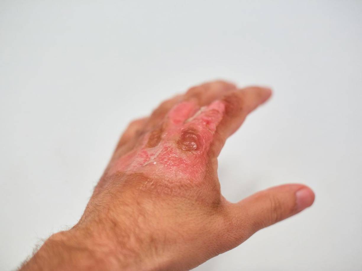 El pasado 30 de noviembre se confirmó la muerte de una de las víctimas del ataque, ocurrido el 28 de agosto en Argentina.