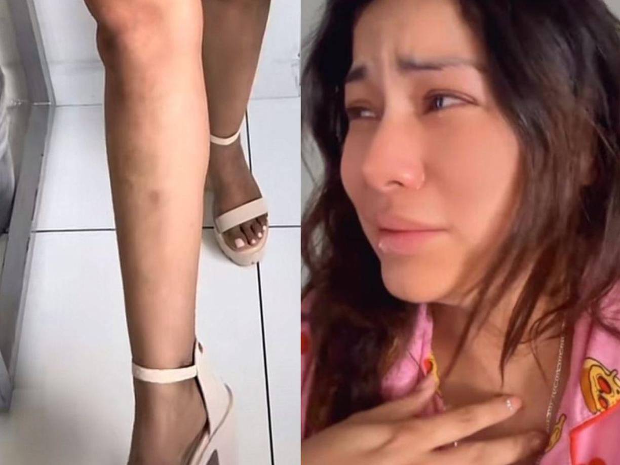 La popular Elsa Oseguera ha sorprendido recientemente en redes sociales al mostrar moretones en su cuerpo. 