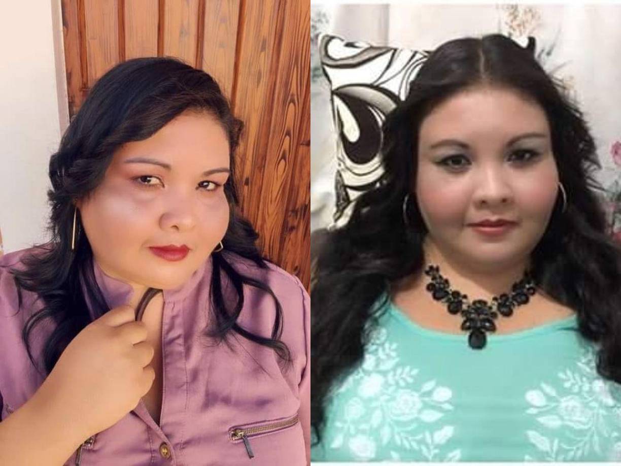 Cristina Lagos estuvo hospitalizada una semana en el Hospital del Sur en Choluteca adonde llegó con fuertes dolores luego de sacarse una muela.