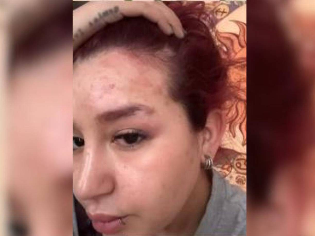 “Vaya sorpresa lo que tengo es herpes zóster. La razón es que somaticé mis emociones”.