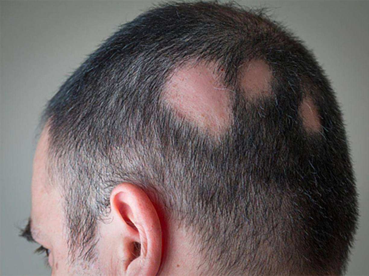 De acuerdo con Mayo clinic, la alopecia areata es una enfermedad autoinmune que provoca la pérdida de cabello en parches redondeados en el cuero cabelludo, la barba o cualquier otra parte del cuerpo con folículos pilosos. Es una condición común que puede afectar a personas de todas las edades, géneros y razas.