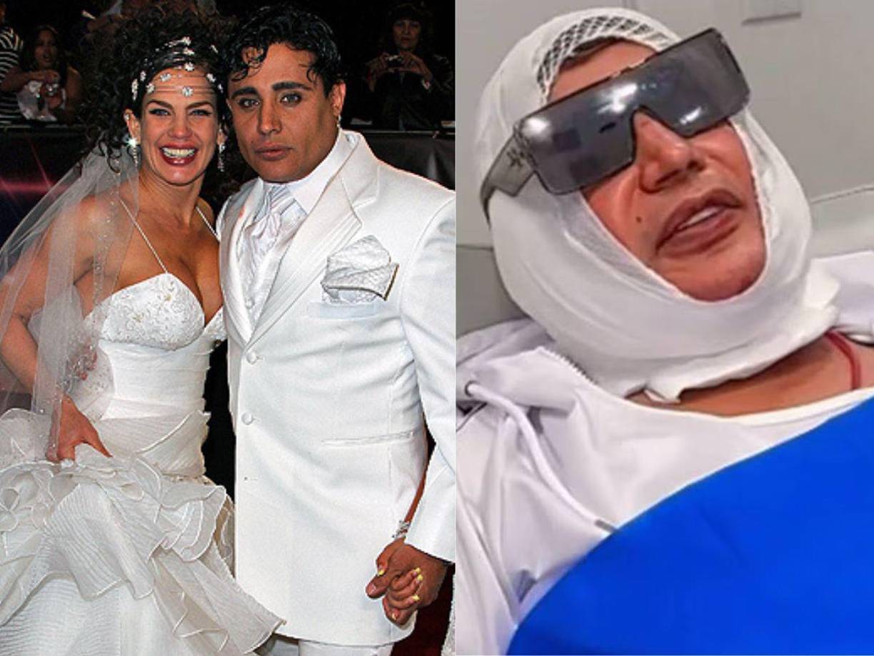 El cubano se había reportado bien después de la operación, sin embargo, después fue intubado.