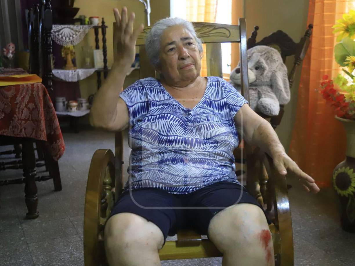 “Yo salí de la iglesia, venía de un estudio bíblico, cuando yo crucé la calle sin ningún problema, vi el vehículo estacionado y me crucé a la otra calle, pero de repente el vehículo retrocedió y sentí el impacto en mi cuerpo, no supe más hasta que llegue al hospital”, relató Figueroa.