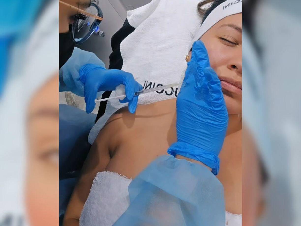 La mesoterapia es un tratamiento no invasivo que consiste en inyectar sustancias activas en la piel para reducir la papada.