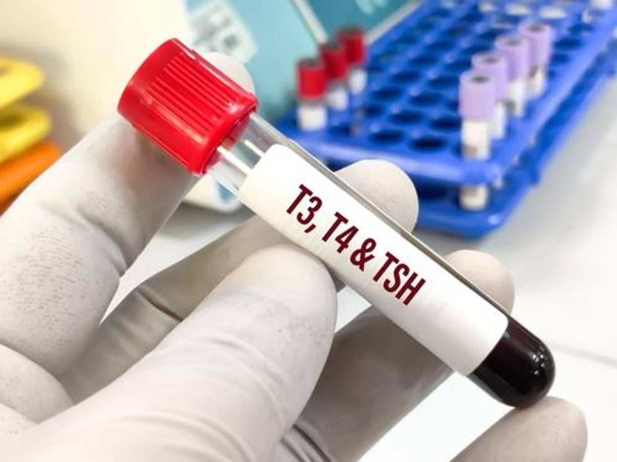 El diagnóstico del hipotiroidismo se realiza mediante análisis de sangre que miden los niveles de hormonas tiroideas. El tratamiento generalmente incluye la administración de hormonas tiroideas sintéticas para normalizar los niveles hormonales y aliviar los síntomas.