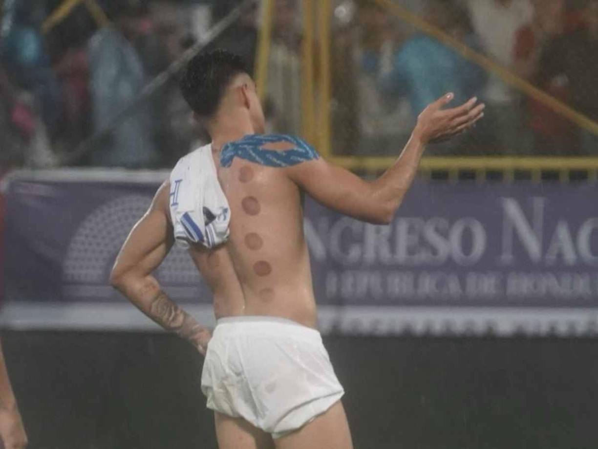 La técnica del cupping consiste en colocar una ventosa con forma de copa sobre la piel de la persona que reciba el tratamiento.<b> Después se crea una bomba de aire utilizando calor para crear una succión entre la copa y la piel,</b> tirando esta última ligeramente hacia arriba y lejos de los músculos subyacentes. Esto causa una congestión local y las manchas que, precisamente,<b> son el resultado de ese proceso. </b>