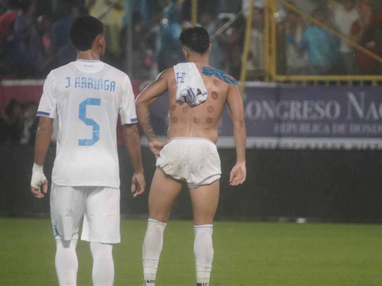 Fisiológicamente, las ventosas extraen la sangre en las zonas afectadas, <b>reducen el dolor y aceleran la curación de los músculos sobrecargados</b> de trabajo. 