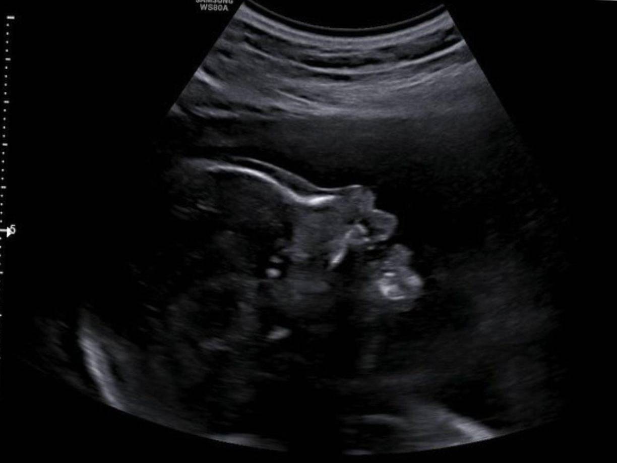 “Dejó de responder a mis mensajes después de que le envié una foto de la ecografía en 3D”, reveló la hija de Ginola.