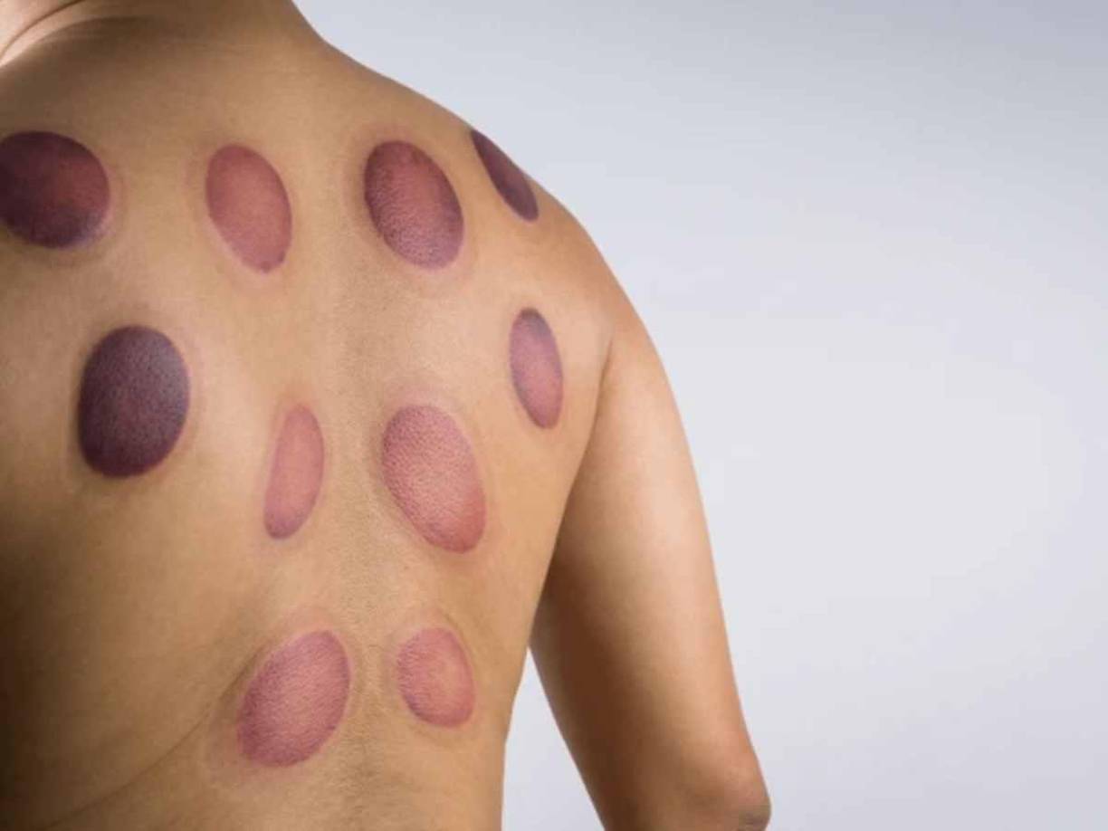  Esta curiosa práctica tiene su origen en China y se trata de una técnica de la medicina tradicional de dicho país. Su objetivo es ayudar a los músculos doloridos a la vez que mejora la circulación sanguínea.