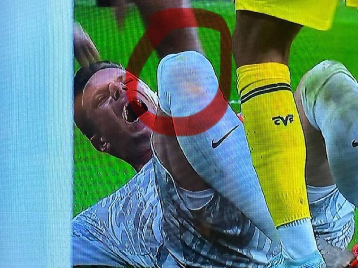 El guardameta ya tuvo problemas en esa misma rodilla hace ahora tres años, cuando tuvo que ser intervenido hasta en dos ocasiones por una lesión en el tendón rotuliano. 