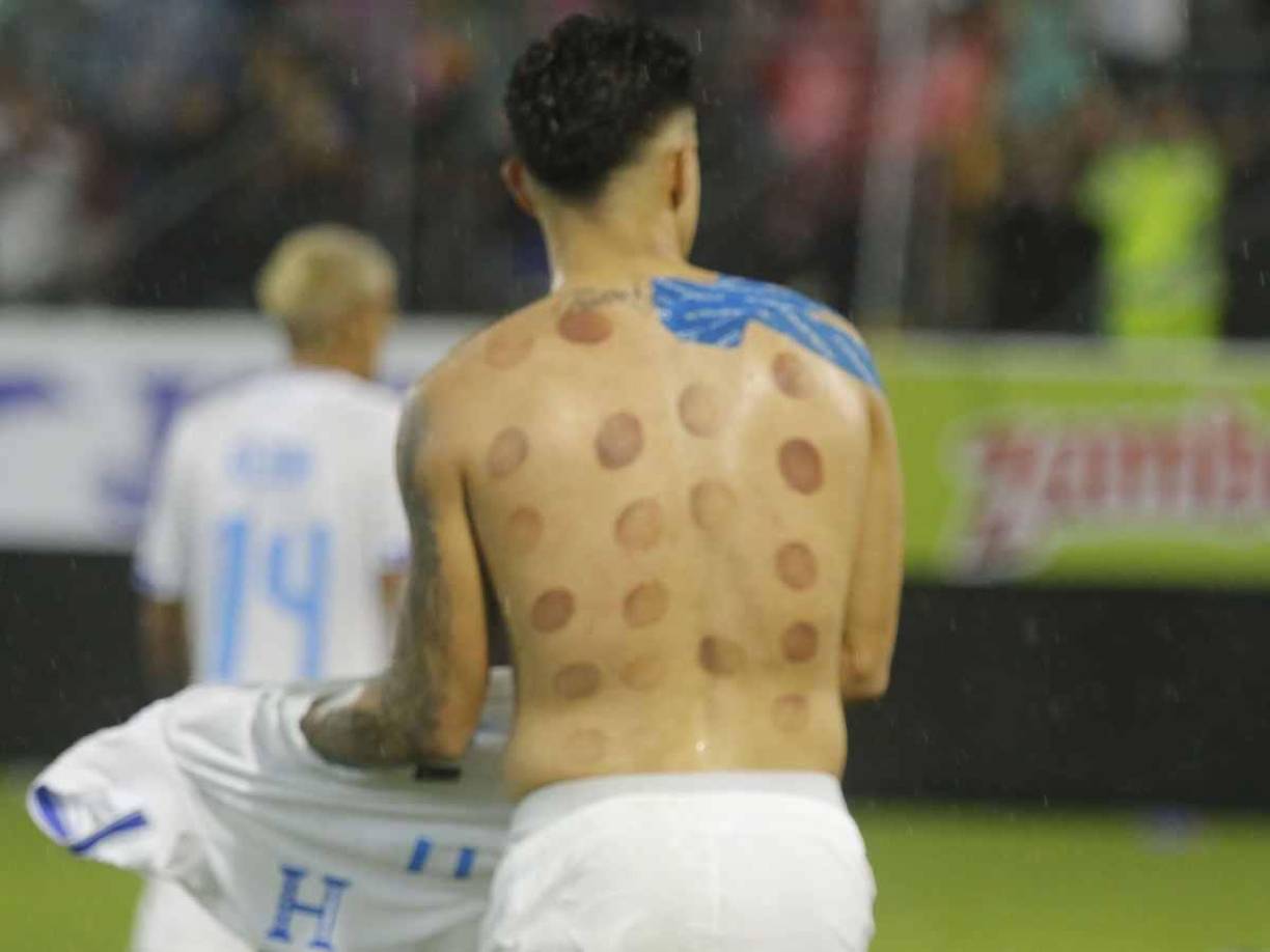 Luis Palma es el hombre del momento luego de que marcó dos goles que le dieron la victoria a la selección de Honduras ante México en el estadio Morazán. Conoce la curiosa razón de sus moretones en la espalda.