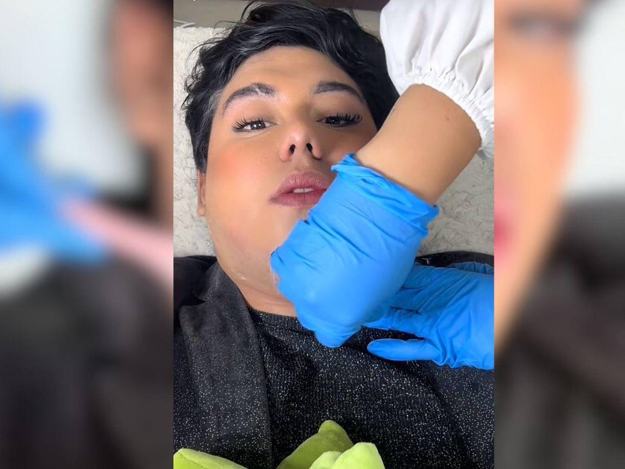 Mediante sus redes sociales, el influencer explicó cada detalle de su proceso estético