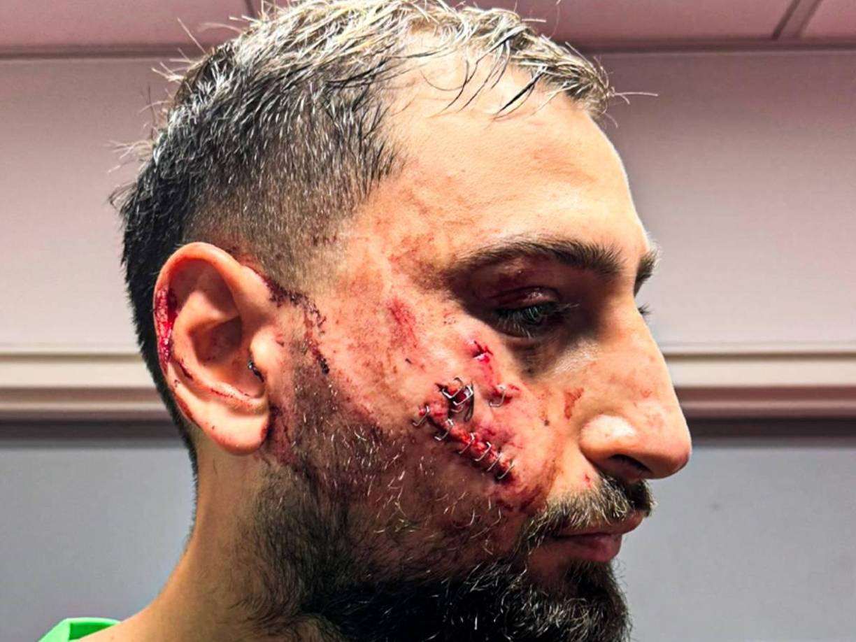 Así le quedó el rostro a Donnarumma tras el terrible planchazo sufrido en el duelo ante Mónaco.