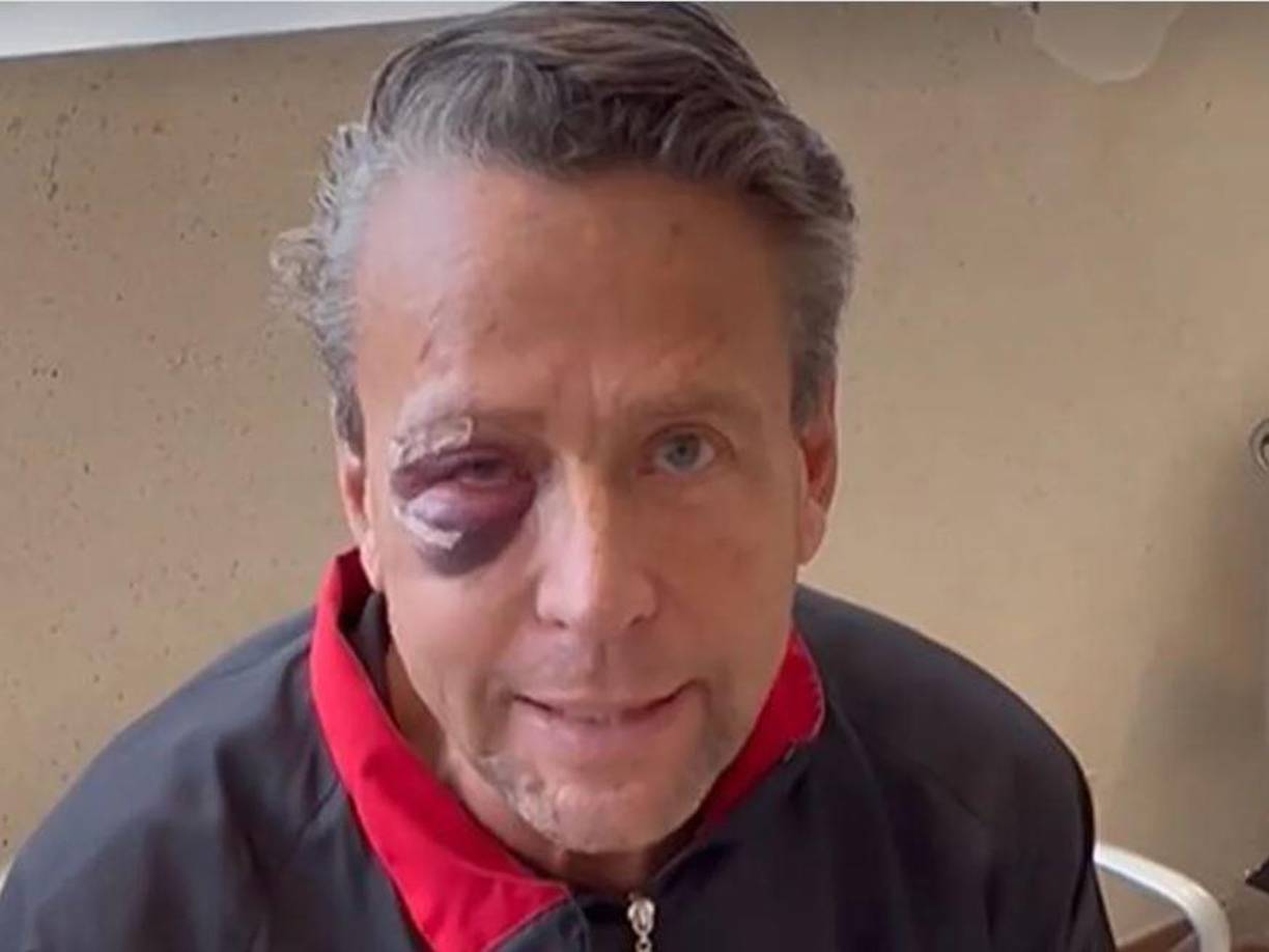 Incluso casi pierde la visión de un ojo debido a un puñetazo que le dieron que le produjo un desprendimiento de retina.