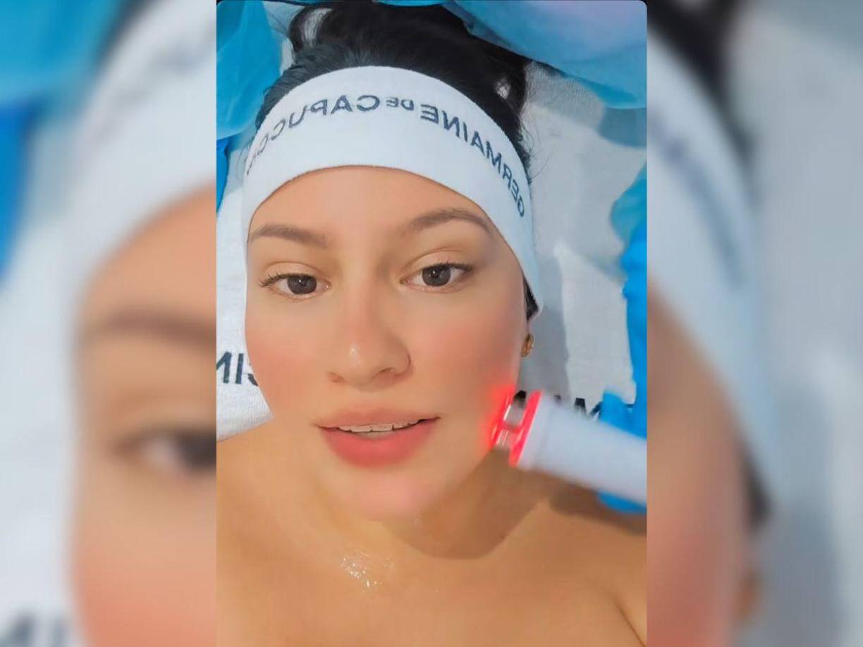 Sin embargo, mediante sus redes sociales reveló que se ha sometido a un nuevo procedimiento estético, ahora en su rostro. 