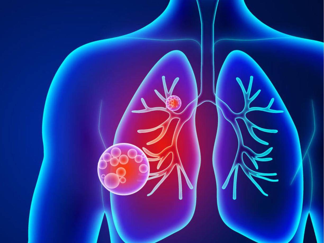 Los pacientes suelen recibir antibióticos para combatir la neumonía, y la mayoría mejora en un plazo de dos a cuatro semanas. Pero algunos pacientes de los grupos de mayor riesgo pueden ser ingresados en el hospital.