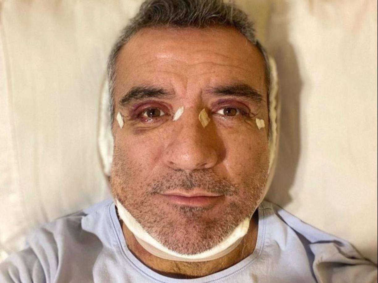 El que fuera presentador del reality show de Telemundo La casa de los famosos se hizo dos “arreglitos”: ritidoplastia y blefaroplastia.