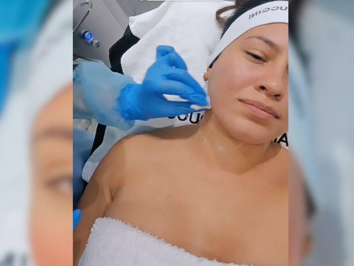 Este tratamiento se realiza en la capa media de la piel, también conocida como mesodermo, de ahí su nombre.