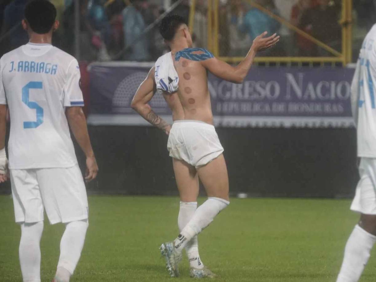 Es una vieja práctica de la medicina tradicional china que está de moda en los deportistas.