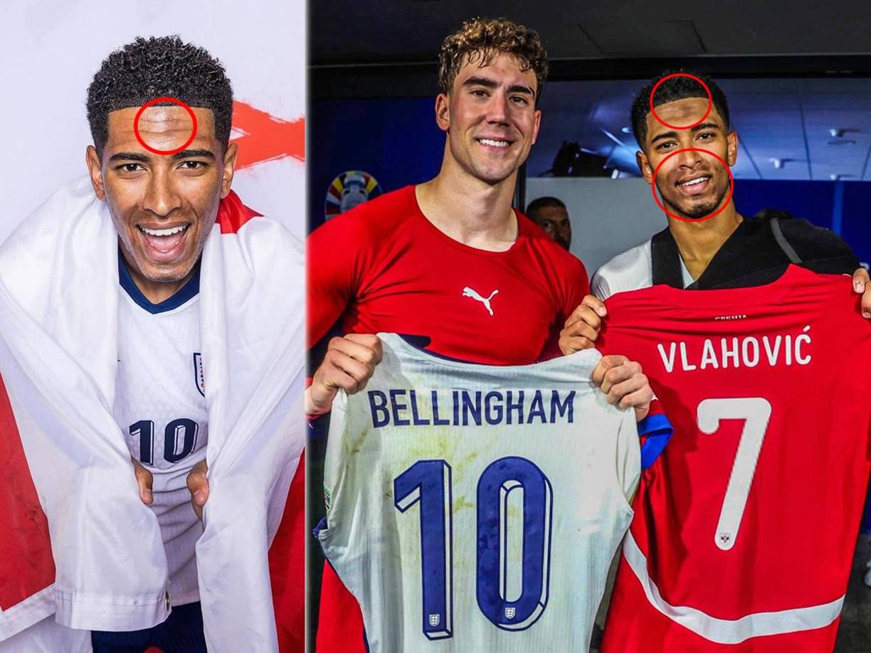 Jude Bellingham se ha vuelto viral por un detalle en su rostro que tiene alarmados a muchos en las redes sociales, sobre todo después del debut de Inglaterra en la Eurocopa 2024.