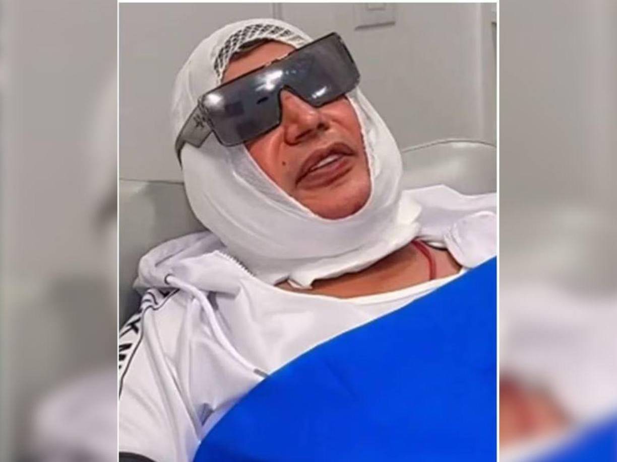 No es la primera vez que el artista de 53 años se comete a una cirugía estética; luego de la cirugía, Eduardo Antonio apareció en recuperación junto a su médico, vendado del rostro y con lestes oscuros, el especialistas aseguró que todo había salido bien y felicitó al intérprete por tener una piel de una persona de “16 años”.