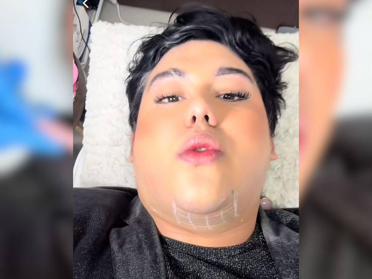 La lipopapada es un procedimiento estético que elimina la grasa acumulada en la zona del cuello, desde el mentón hasta el cuello.