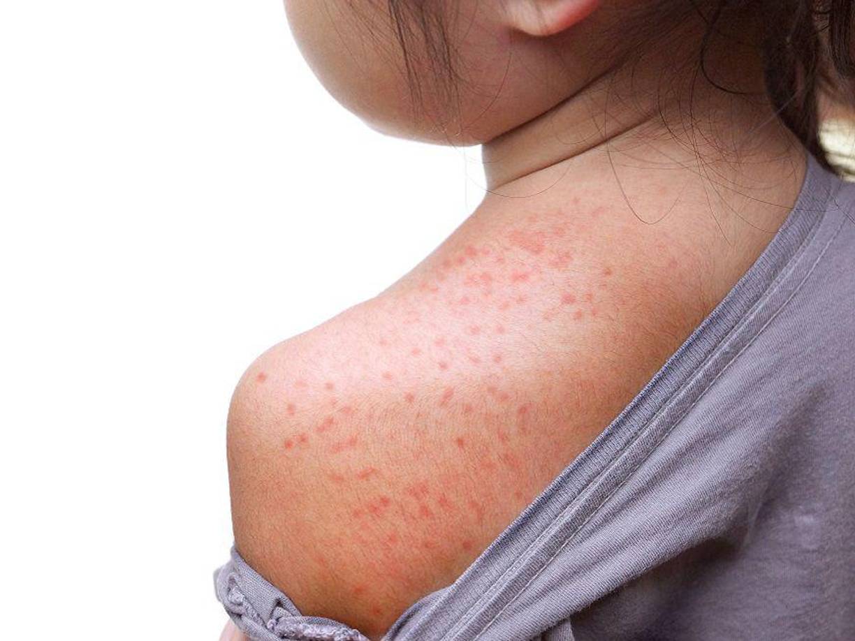 La educación y la prevención son claves para controlar la viruela del mono. Conocer los síntomas y seguir las recomendaciones de salud puede ayudar a protegernos y a proteger a nuestra comunidad.