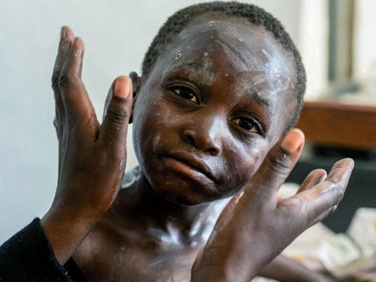 Los expertos quieren “determinar la causa de una enfermedad aún no diagnosticada” notificada en la provincia de Kwango, especialmente en la localidad de Panzi, explicó la oficina de la OMS para África en un comunicado.