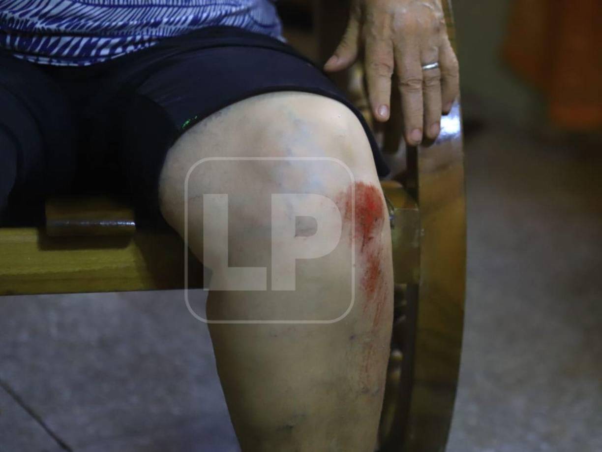 Con varios raspones en su cuerpo, y un poco acongojada por el traumático momento, doña María Figueroa manifestó que el hecho ocurrió cuando venía de un estudio bíblico de la iglesia que visita.