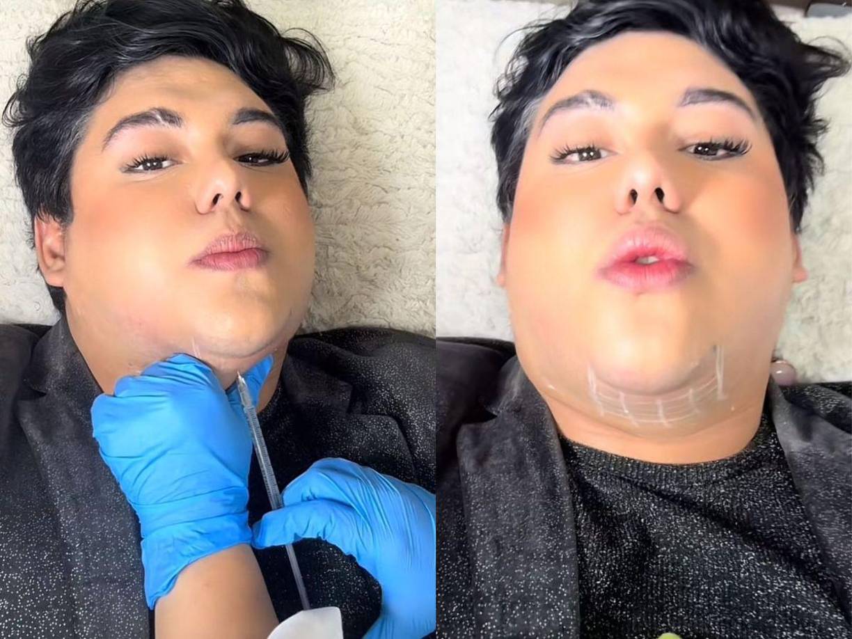 El crítico de moda hondureño compartió en sus redes sociales el nuevo procedimiento estético al que se sometió. 