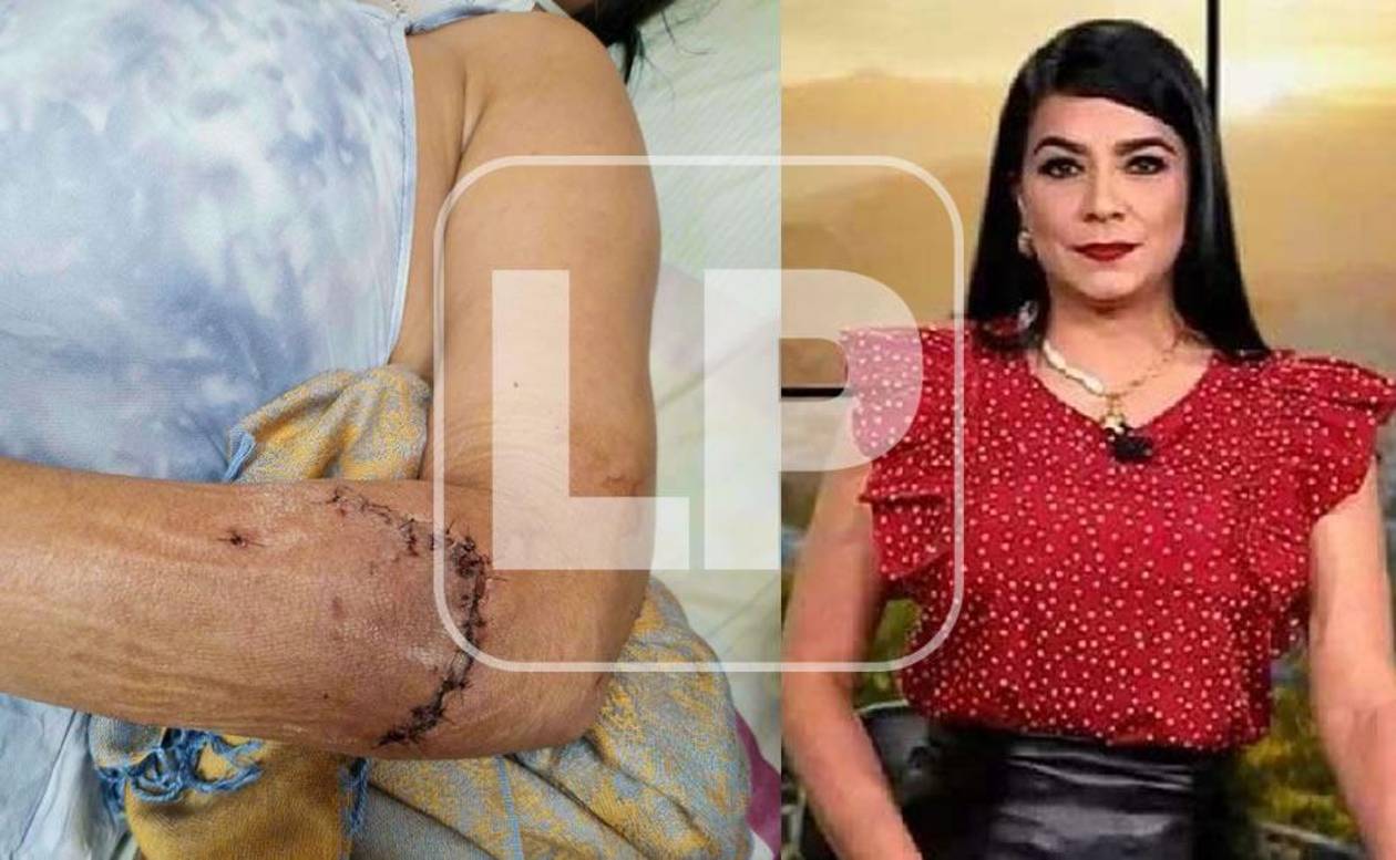 Periodista atacada por pitbull: “He quedado con temor cuando veo a otro animal”