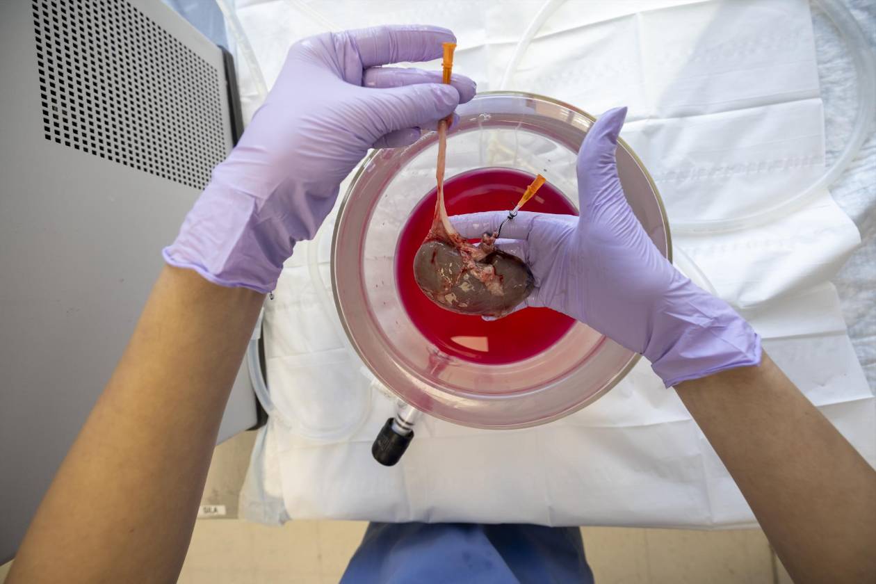 Avance histórico: Trasplantan con éxito un riñón que estuvo congelado 10 días