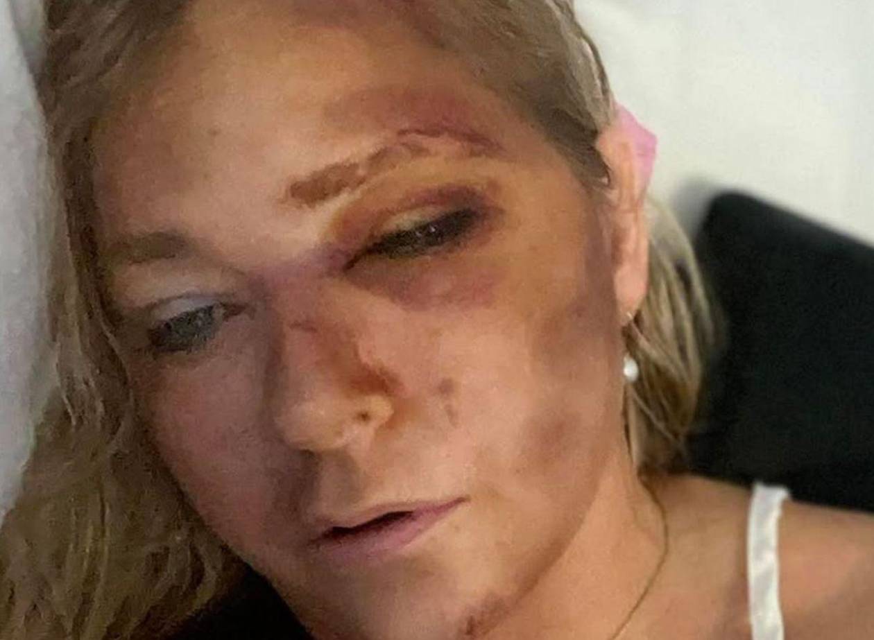 Mujer que acusó al príncipe Andrés y a Epstein de abuso fue atropellada por un autobús